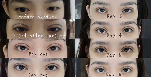 Không phải ai cũng biết nhấn mí mắt có hại không và cần lưu ý gì-3