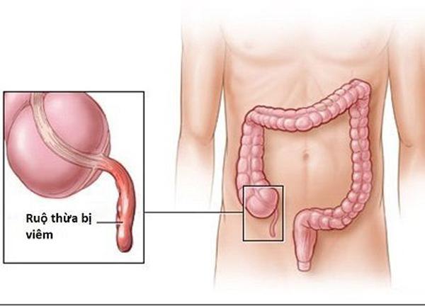 Những dấu hiệu viêm ruột thừa nhất định không được chủ quan-1