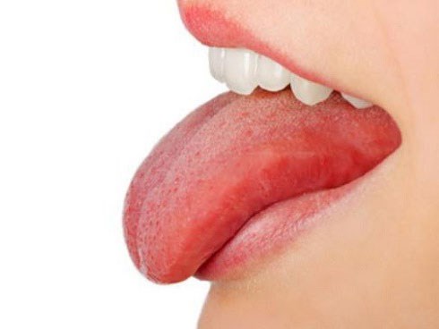 Đừng nhầm lẫn ung thư lưỡi và nhiệt miệng