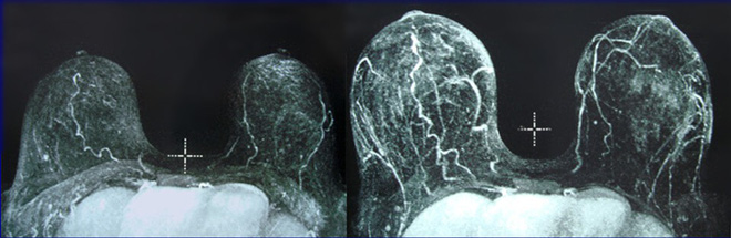 Thực hư phương pháp nâng ngực bằng máy hút, biến sân bay thành đồi núi đang được chị em chia sẻ rầm rộ-10