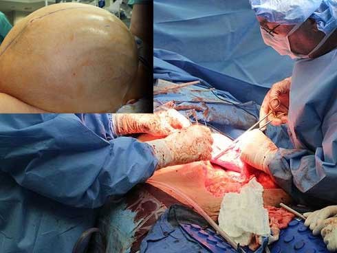Ca cực hiếm: Người phụ nữ mang khối u buồng trứng 60kg