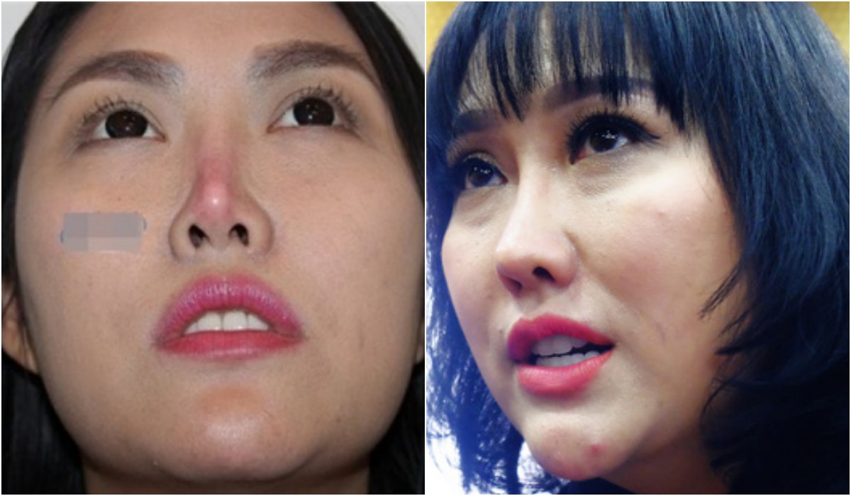 Những bộ phận bị cho là biến dạng sau phẫu thuật thẩm mỹ của sao Việt giờ ra sao?-16