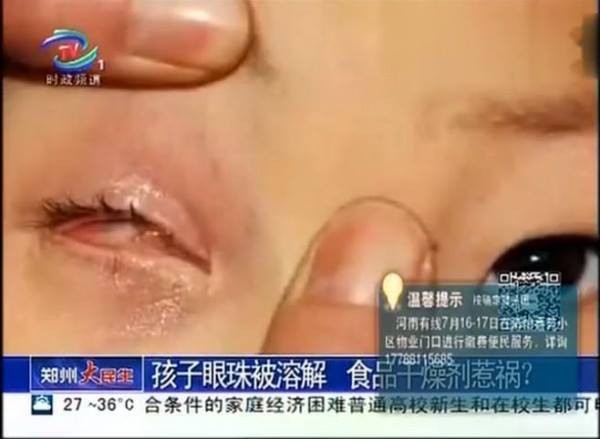 Bé 8 tuổi bị mù 1 mắt vĩnh viễn chỉ vì chiếc túi hút ẩm nhỏ xíu-1