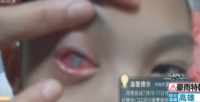 Bé 8 tuổi bị mù 1 mắt vĩnh viễn chỉ vì chiếc túi hút ẩm nhỏ xíu-2