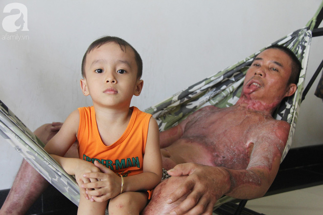 Bị điện giật cháy người không có tiền chạy chữa, bố xót xa nhìn con trai 4 tuổi không nhận ra mình-7