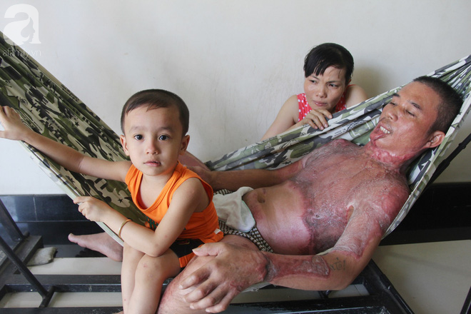 Bị điện giật cháy người không có tiền chạy chữa, bố xót xa nhìn con trai 4 tuổi không nhận ra mình-11