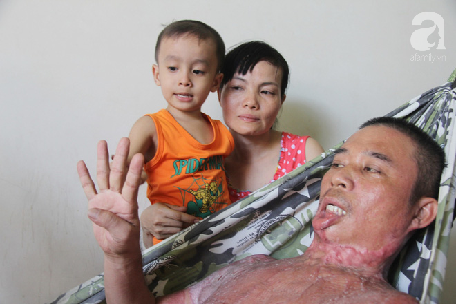 Bị điện giật cháy người không có tiền chạy chữa, bố xót xa nhìn con trai 4 tuổi không nhận ra mình-1