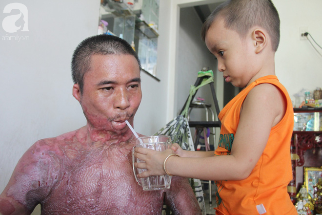 Bị điện giật cháy người không có tiền chạy chữa, bố xót xa nhìn con trai 4 tuổi không nhận ra mình-3
