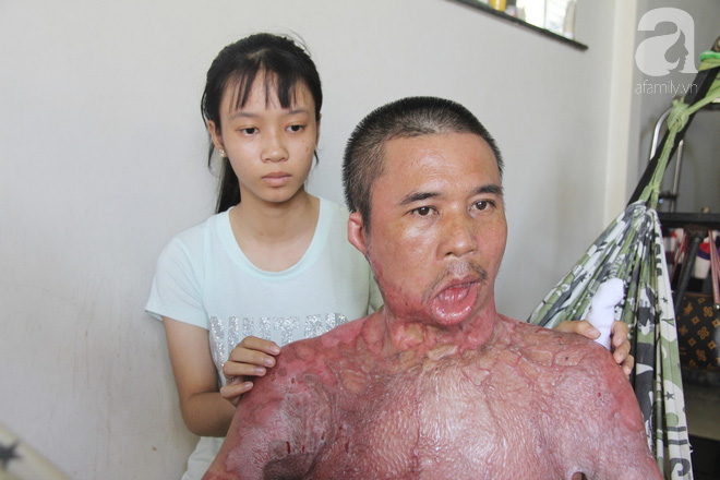 Bị điện giật cháy người không có tiền chạy chữa, bố xót xa nhìn con trai 4 tuổi không nhận ra mình-9