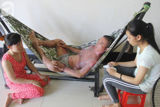 Bị điện giật cháy người không có tiền chạy chữa, bố xót xa nhìn con trai 4 tuổi không nhận ra mình-13