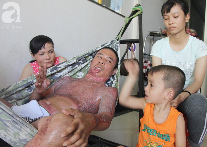 Bị điện giật cháy người không có tiền chạy chữa, bố xót xa nhìn con trai 4 tuổi không nhận ra mình-14