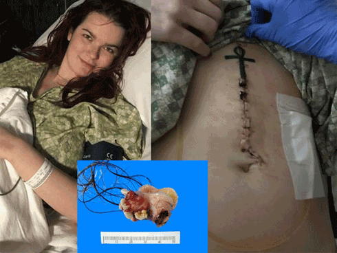 Tưởng chỉ đau ruột thừa, cô gái choáng váng khi biết mình có khối u toàn tóc, răng, xương