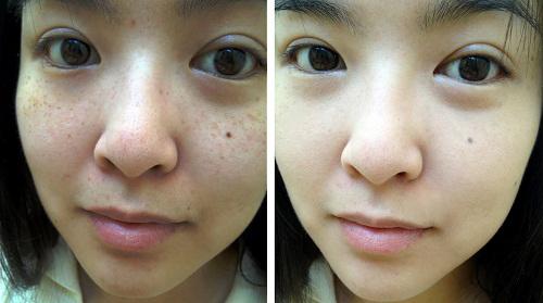 Bị nám da, cứ lấy nắm giá đỗ và củ cải làm thế này sau 2 tuần là sạch bách-9