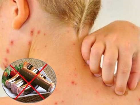 Bệnh thủy đậu kiêng gì và nên ăn gì để nhanh khỏi