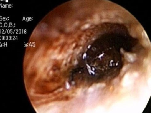Bé trai 9 tuổi đang ngủ bị 'vật thể lạ' chui vào tai suýt thủng màng nhĩ