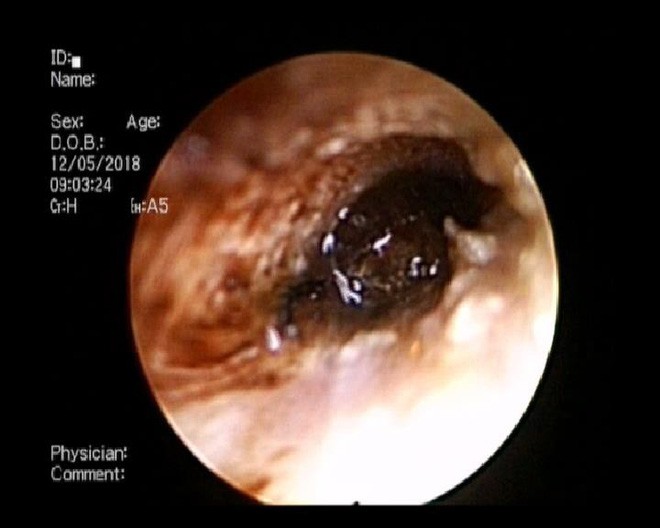 Bé trai 9 tuổi đang ngủ bị vật thể lạ chui vào tai suýt thủng màng nhĩ-2