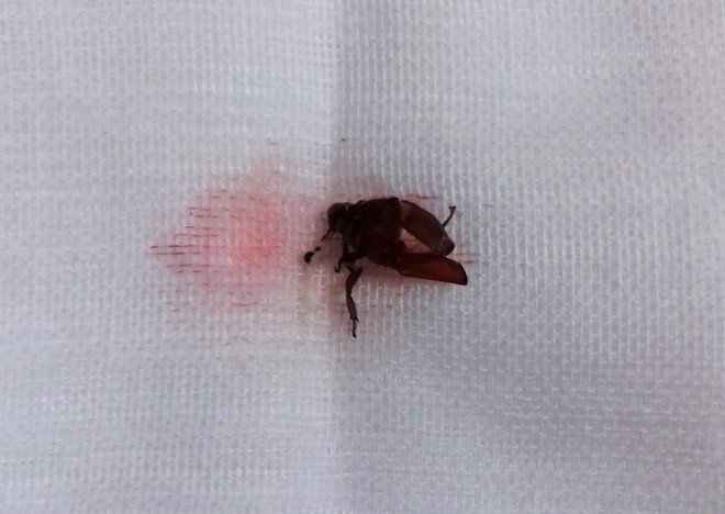 Bé trai 9 tuổi đang ngủ bị vật thể lạ chui vào tai suýt thủng màng nhĩ-3