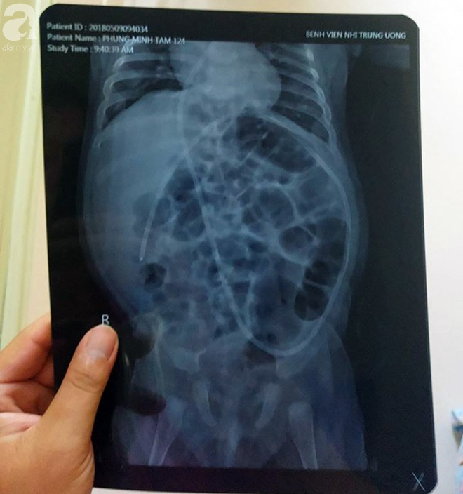 Tiếng khóc xé lòng của bé trai hơn 5 tháng tuổi mắc bệnh não úng thủy-5