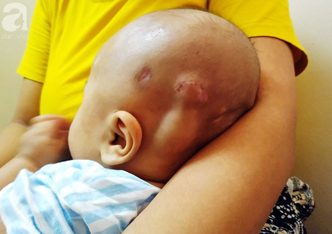 Tiếng khóc xé lòng của bé trai hơn 5 tháng tuổi mắc bệnh não úng thủy-7