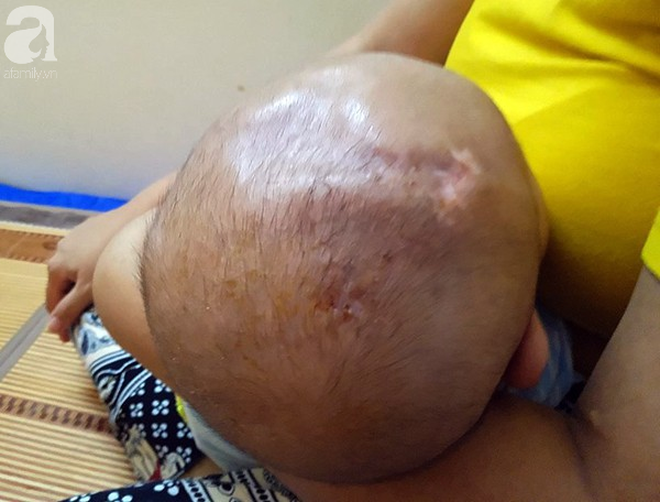 Tiếng khóc xé lòng của bé trai hơn 5 tháng tuổi mắc bệnh não úng thủy-8