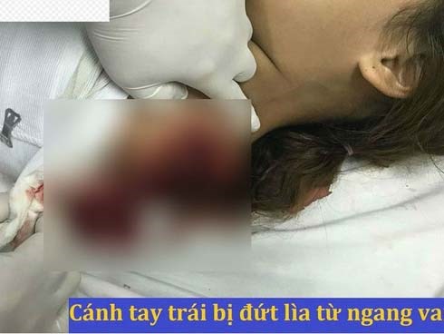 Chơi trốn tìm cùng bạn, bé gái bị máy cưa cắt đứt lìa cánh tay trái vĩnh viễn