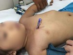 TP.HCM: Bé trai 9 tuổi bị bút chì do bạn đùa để dưới ghế đâm xuyên mông-5