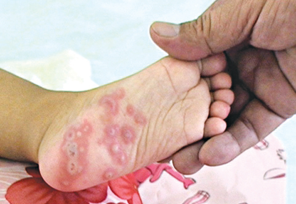 Cách nhận biết, điều trị, phòng ngừa bệnh tay chân miệng ở trẻ em-2