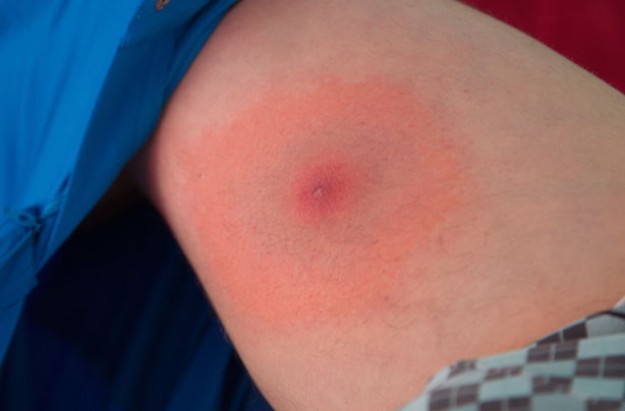 Chuyên gia cảnh báo sự bùng nổ của một loài bọ gây bệnh nguy hại cho trẻ trong mùa hè-4