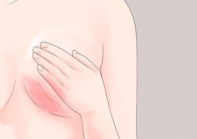 5 dấu hiệu nhận biết bệnh ung thư vú mà con gái không nên chủ quan xem thường-2