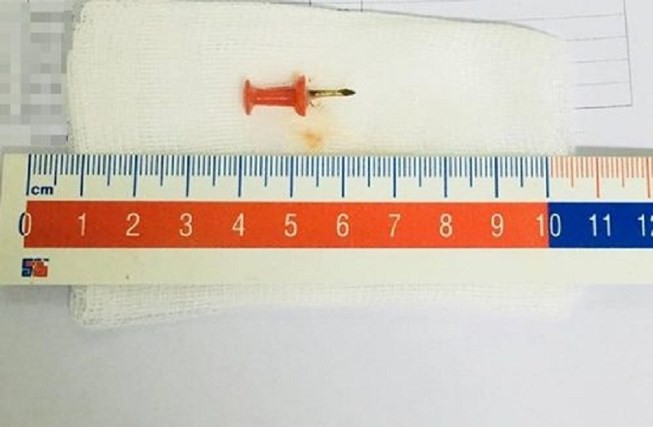 Nuốt phải đinh sắt 1,5cm vào bụng, bé 2 tuổi suýt chết-1