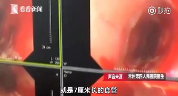 Thực quản bị rách đôi 7cm chỉ vì thói quen chữa nghẹn 90% mọi người đều làm-1