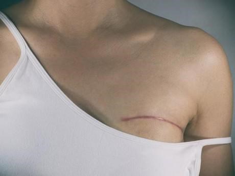 Cô gái 23 tuổi có 13 cục u vú vì thức đêm: mua ngay 7 thực phẩm để phòng ngừa