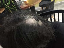 Mẹ chồng lên tiếng về nghi vấn đổ keo 502 lên đầu con dâu cũ Mẹ chồng lên tiếng về nghi vấn đổ keo 502 lên đầu con dâu cũ