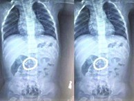 Hình chụp X-quang dạ dày bé 14 tháng tuổi khiến phụ huynh 'tá hỏa' vì món đồ chơi của con
