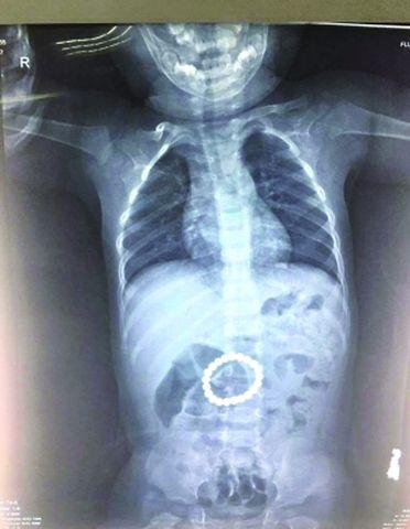Hình chụp X-quang dạ dày bé 14 tháng tuổi khiến phụ huynh tá hỏa vì món đồ chơi của con-1