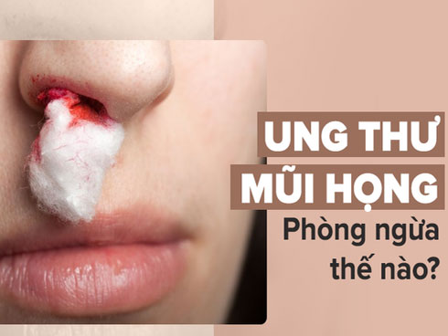 Có những dấu hiệu này phải đi khám ung thư mũi và xoang ngay lập tức kẻo hối không kịp-3
