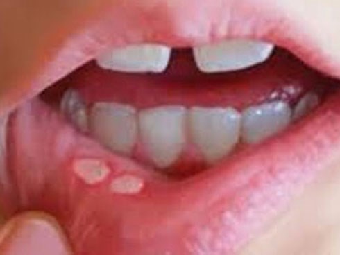 Mẹo nhỏ đánh bay nhiệt miệng ngày hè nhanh nhất