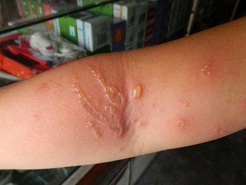 Bé trai chằng chịt vết thương sau va chạm với sứa biển-4