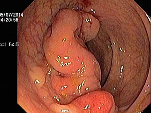 Bác sĩ lý giải vì sao nhiều người trong một nhà cùng bị ung thư đại trực tràng-2