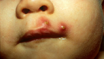 Cách trị mụn nhọt mùa hè đơn giản nhưng hiệu quả không tưởng”‎-1