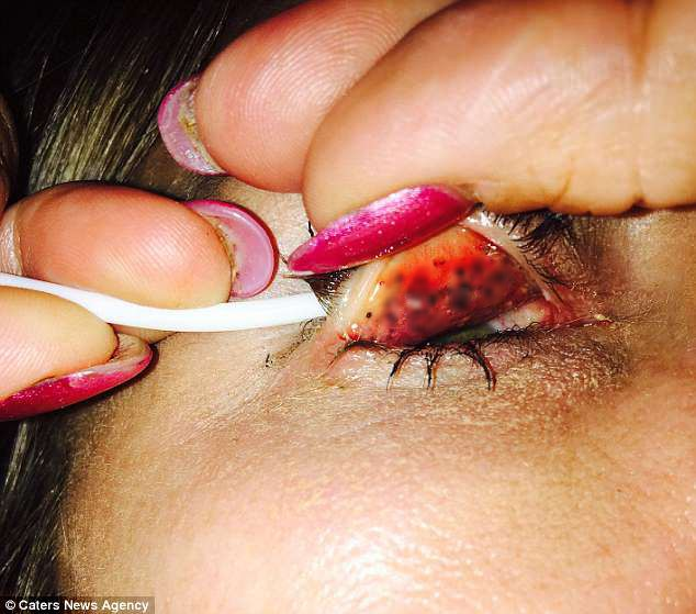 Chuốt mascara 25 năm không tẩy trang, người phụ nữ phải trả giá đắt cho sự lười biếng của mình-2