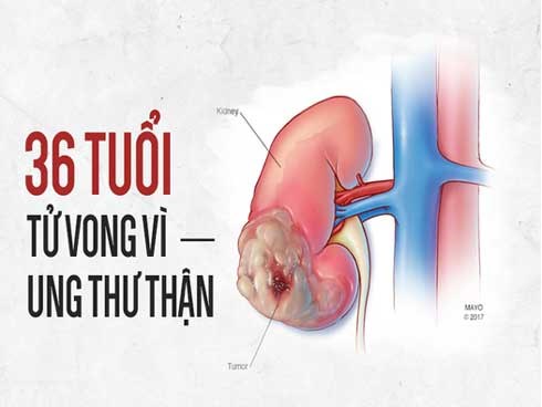 36 tuổi bị tử vong vì ung thư thận: Bác sĩ cảnh báo những thói quen bạn nên xem lại