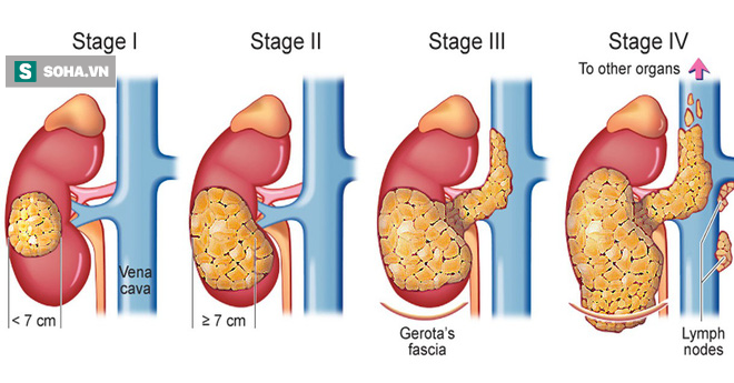 36 tuổi bị tử vong vì ung thư thận: Bác sĩ cảnh báo những thói quen bạn nên xem lại-3