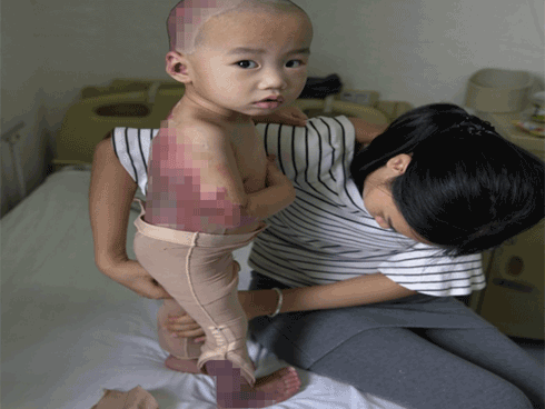 Hoàn cảnh thương tâm của bé trai 17 tháng tuổi bị bỏng toàn thân do một phút bất cẩn của bà