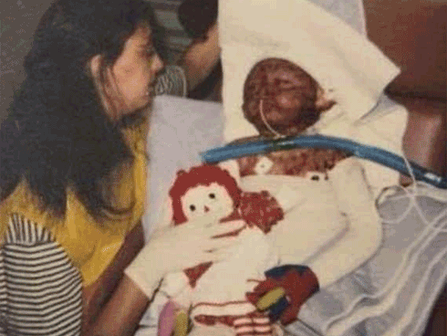 2 tuổi đã bị bỏng toàn thân vì máy giặt phát nổ, hơn 20 năm sau ai cũng bất ngờ về ngoại hình của cô bé năm xưa