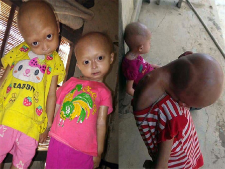 Một dòng họ ở Tiền Giang bị dị tật càng cua hiếm gặp-6