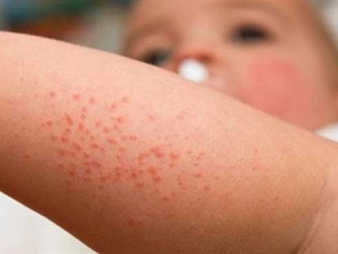4 loại lá giúp trẻ mát da, trị rôm sảy mùa hè hiệu quả