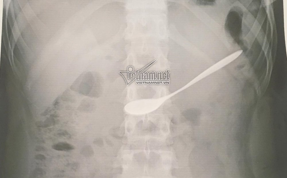 Uống cà phê, cô gái nuốt chửng thìa vào bụng-1