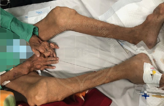 10 năm uống thuốc giảm đau, người đàn ông biến dạng-2