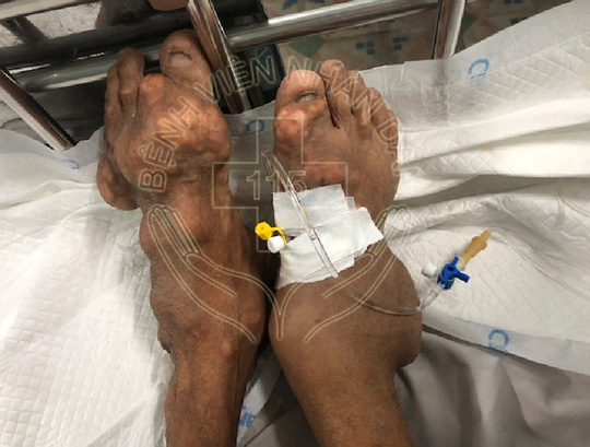 10 năm uống thuốc giảm đau, người đàn ông biến dạng-1